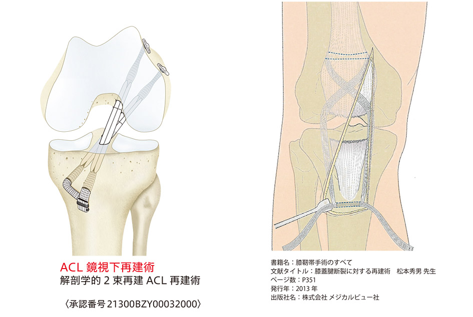 Leeds-Keio補強用メッシュⅡ　人工靭帯