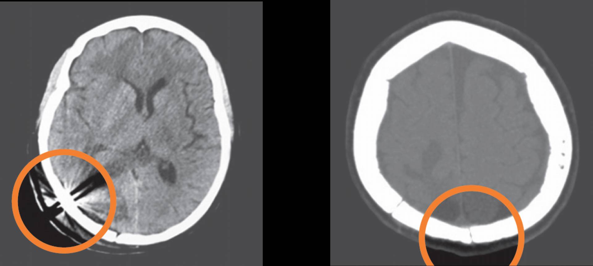 クラニアルループ